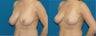 Breast lift (Mastopexy)