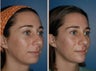 Rhinoplasty