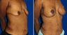 Breast Lift