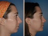 Rhinoplasty