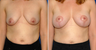 Breast Lift