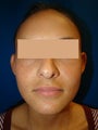 Ear Surgery (Otoplasty)