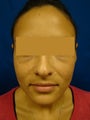 Ear Surgery (Otoplasty)
