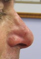 Non-surgical nose job