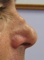 Non-surgical nose job