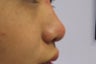 Non-surgical nose job