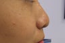 Non-surgical nose job