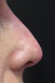 Non-surgical nose job