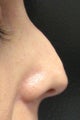 Non-surgical nose job
