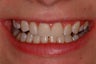 Zoom Advanced Power Inoffice Tooth Whitening