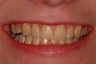 Zoom Advanced Power Inoffice Tooth Whitening