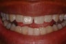 Cosmetic Bonding to Repair Broken Tooth