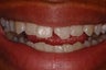 Cosmetic Bonding to Repair Broken Tooth