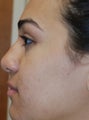 Non-Surgical Rhinoplasty with Silikon-1000