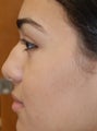 Non-Surgical Rhinoplasty with Silikon-1000