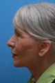Facelift