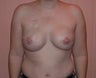 Breast reconstruction