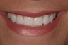 Porcelain Veneers