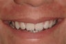 Porcelain Veneers