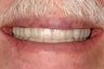 Full mouth reconstruction with crowns and bridges