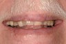 Full mouth reconstruction with crowns and bridges
