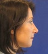 Rhinoplasty