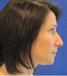 Rhinoplasty