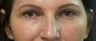 Upper Blepharoplasty