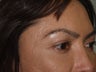 Eyebrow transplant