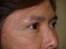 Eyebrow transplant
