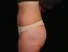 Abdominoplasty, Tummy-Tuck