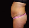 Abdominoplasty, Tummy-Tuck
