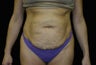 Abdominoplasty, Tummy-Tuck
