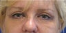 Upper & Lower Blepharoplasty