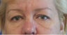 Upper & Lower Blepharoplasty