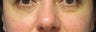 Lower Blepharoplasty Before