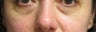 Lower Blepharoplasty Before