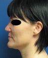 Rhinoplasty