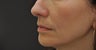 Juvederm Ultra