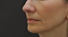 Juvederm Ultra