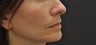 Juvederm Ultra