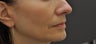 Juvederm Ultra