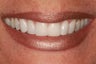Minimal Prep Veneers/ Gum LIft
