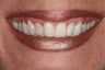 Minimal Prep Veneers/ Gum LIft
