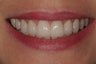 Full Mouth Reconstruction