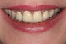 Full Mouth Reconstruction