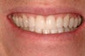 Porcelain Veneers