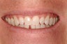Porcelain Veneers