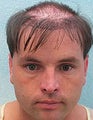 FUE-BHT hair transplantation using head and body hair