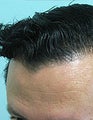 Nape Hair Transplant Patient
